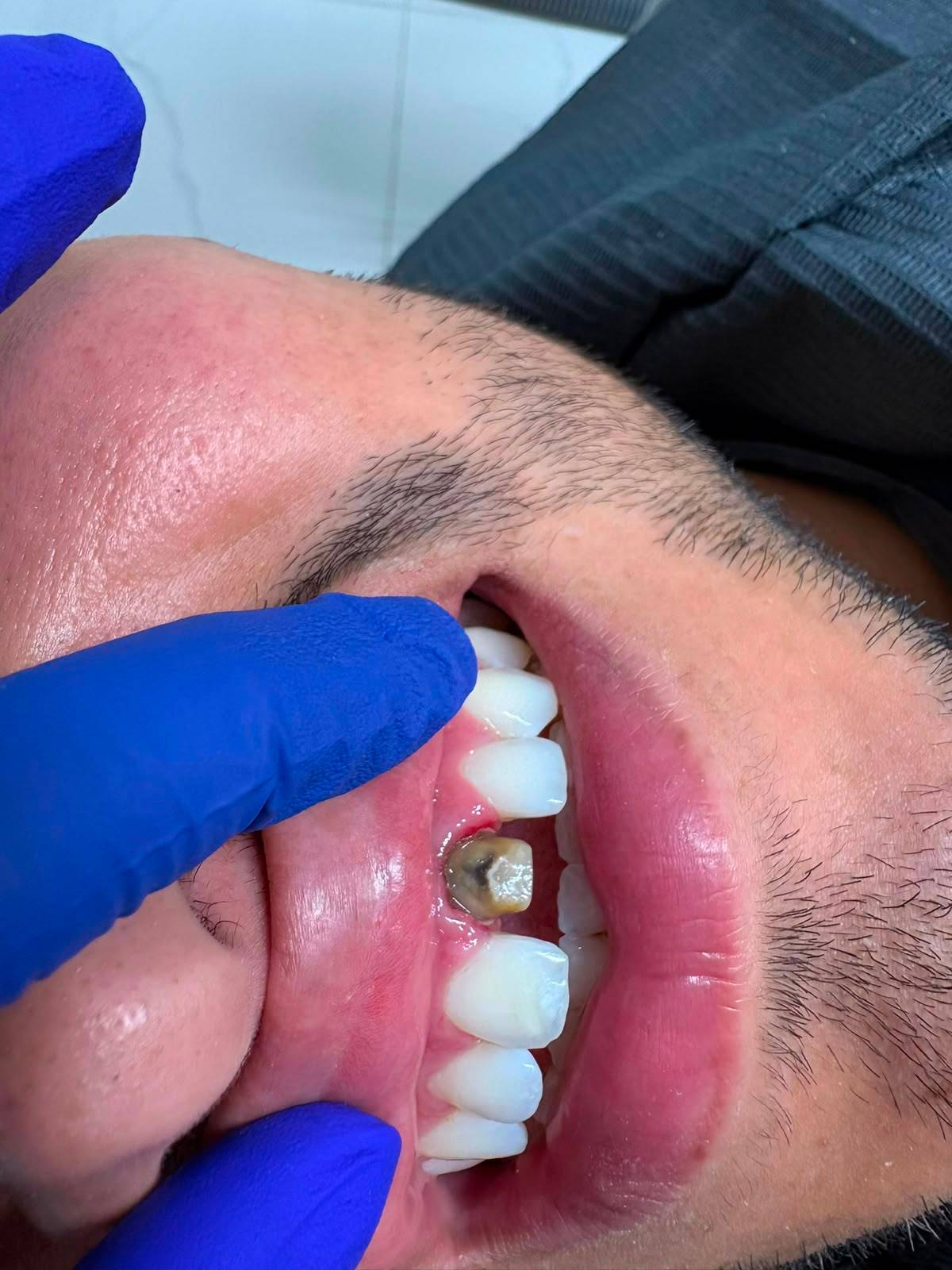 Antes de la rehabilitación oral